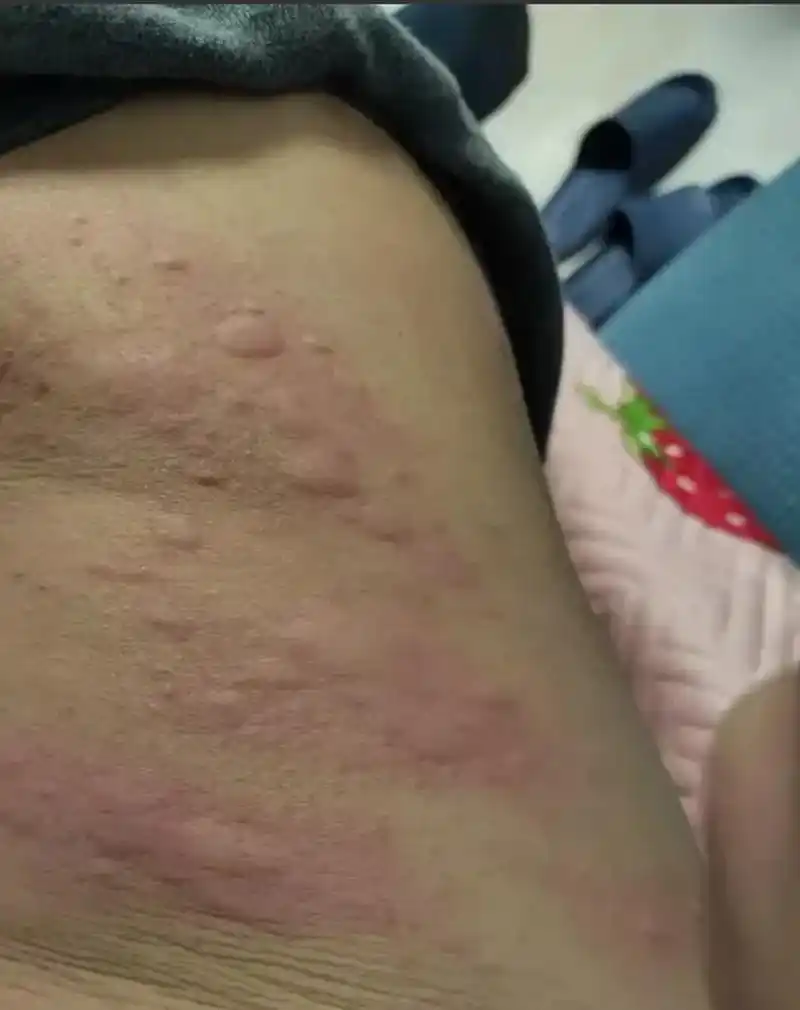 身上出现这种大片"蚊子包" 抓个不停,非常痒,这种就是常见的【荨麻疹
