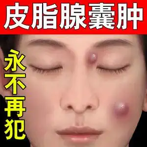 皮脂腺囊肿膏去皮下囊肿粉瘤脂肪瘤痤疮痘痘神器拔毒脓火疖子药膏