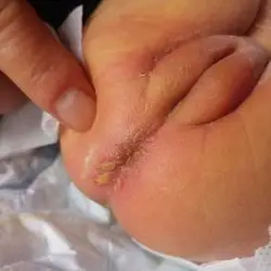 宝宝屁股一块脓包请问怎么回事怎么办