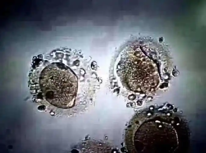 这是一位45岁女性的卵子,虽然有5个成熟的卵子,但是显微镜下明显可以