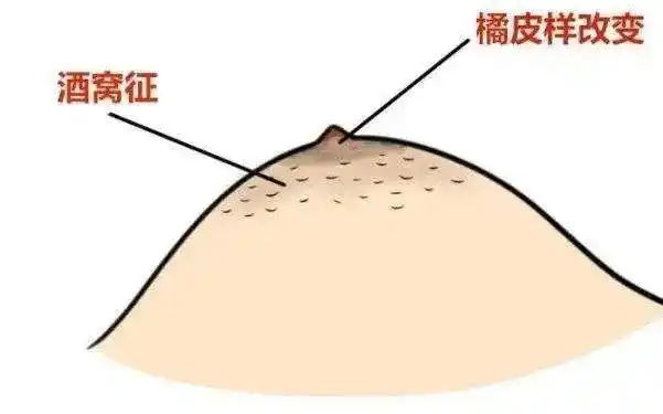 女性身体出现7种情况,可能是乳腺癌早期