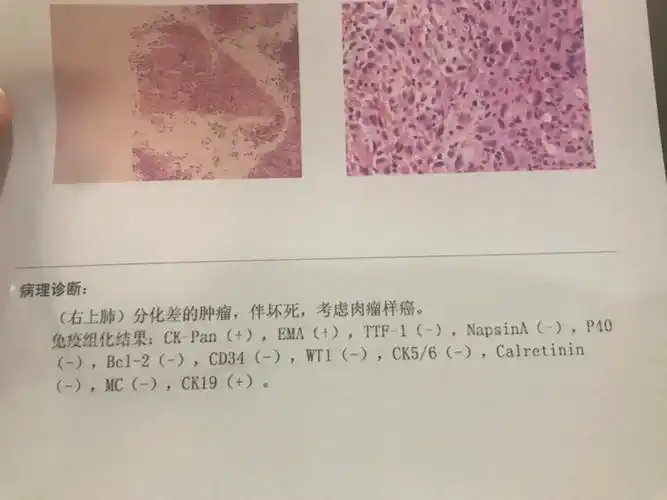 免疫组化结果,请大家帮忙看看