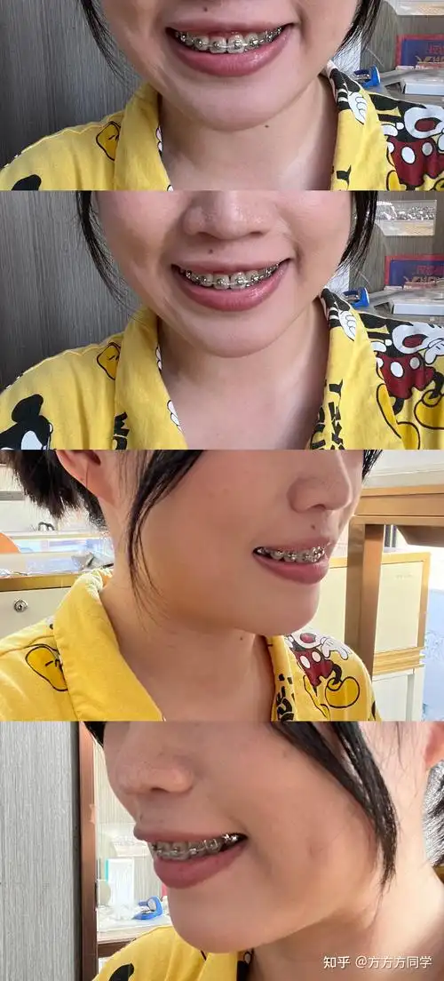 关于成年人牙齿矫正骨性凸嘴