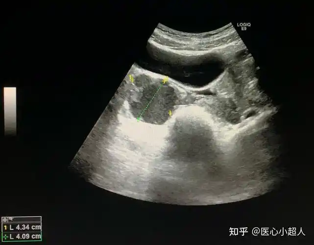 卵巢子宫内膜异位囊肿(巧克力囊肿) - 知乎