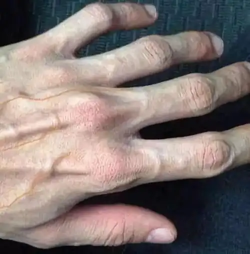 手上青筋越多,说明身体越