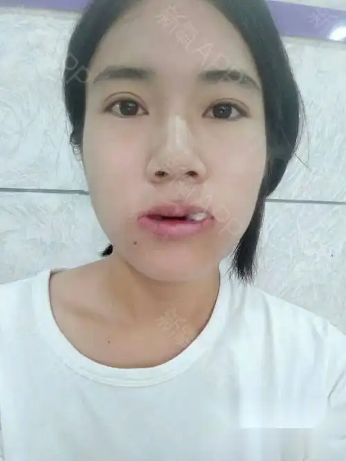 97年的,刚戴牙套不到两个月,地包天还有两颗"虎牙"