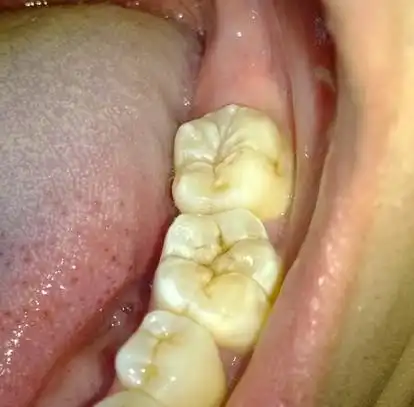 后磨牙发白.脱矿.敏感该怎么处理?