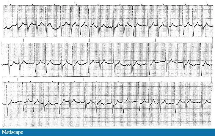 答案:心室传导可变的交界性心动过速,心房颤动,高度提示洋地黄中毒.