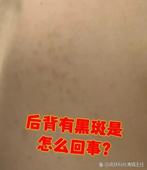 后背出现黑斑可能和多种原因有关,比如色素沉着,营养不足或者真菌