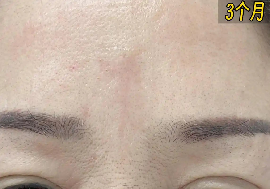 印堂悬针纹是指眉毛正中央的位置出现微小的凹陷或纹路.