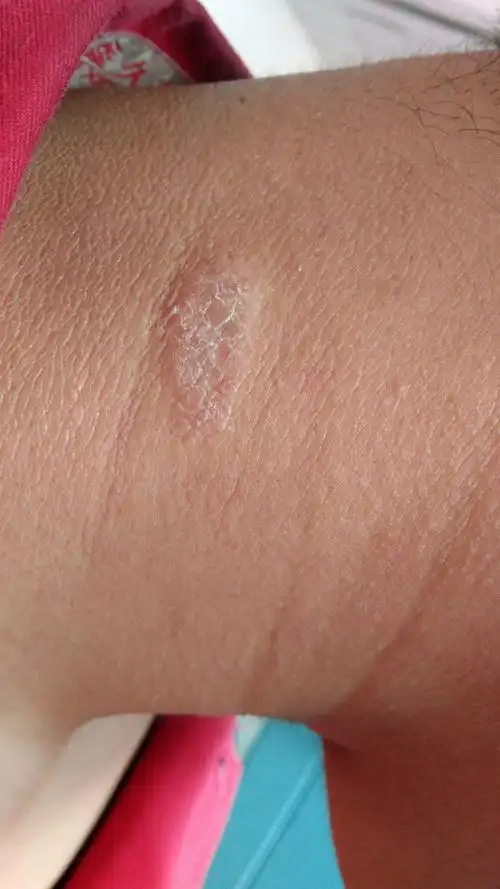 有害么?需要什么药能去除