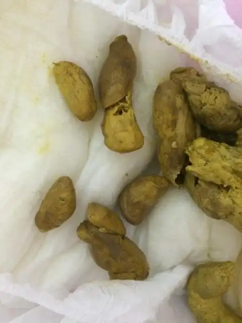 问:宝宝80天,两天没拉粑粑,今天先是拉的硬硬的一坨一坨的,然后就是棉