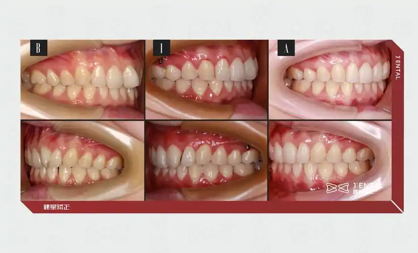 关于隐形矫正你想知道的,这全都有!