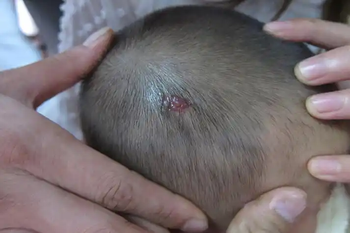 头皮血管瘤图片