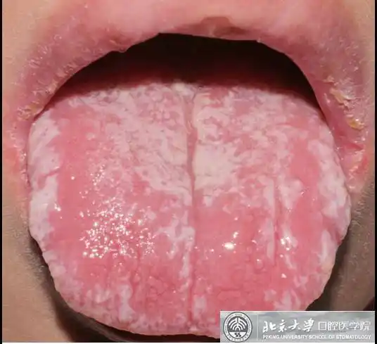 口腔念珠菌病,你了解多少?