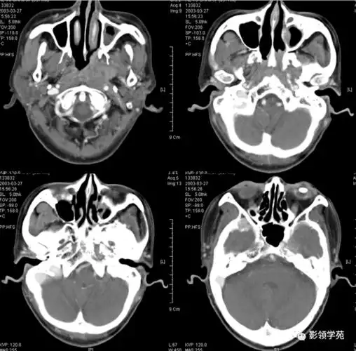 颌面部解剖及其病变的影像诊断_处理