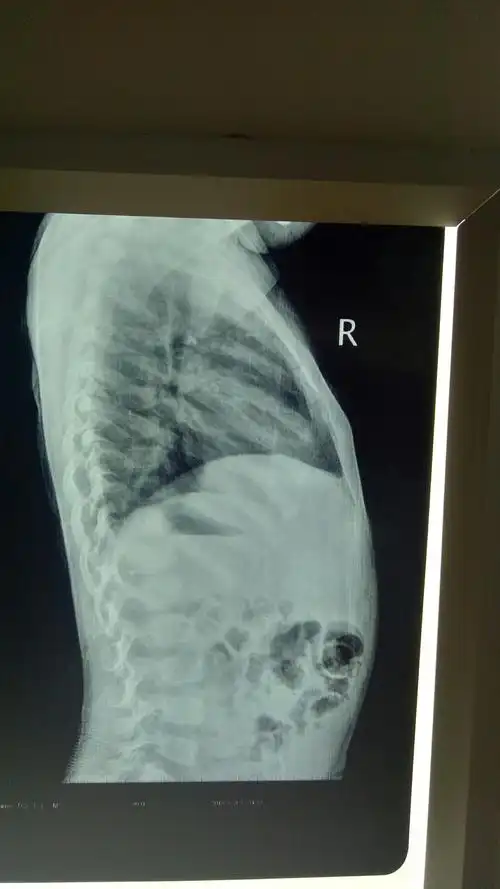 小儿鸡胸,斜肩,走路内八字,这是骨关节错位引起的,不要再盲目的补钙了