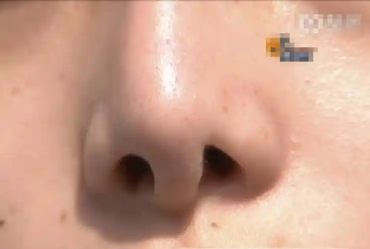 20岁女孩鼻子整形失败,曝光求助:应聘网络主播被拒四五次了