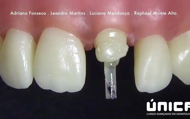 纤维桩医生说给你牙齿打个桩那肯定不是把你的牙当建筑工地了