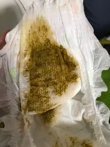 母乳喂养一个半月的宝宝攒肚第三天上午排便粘稠,晚上拉黄色果酱似的