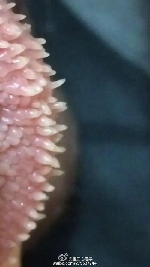 珍珠疹很多人的私处都有虽然无害但是影响美观你们快检查一下