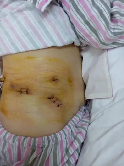 后腹腔镜下活体供肾切取术