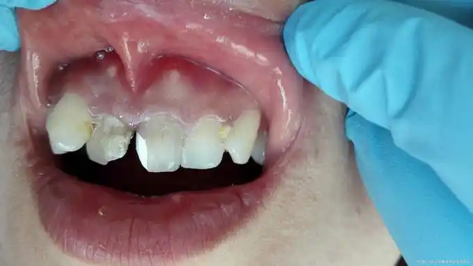 上前牙窦道型慢性根尖周炎一例