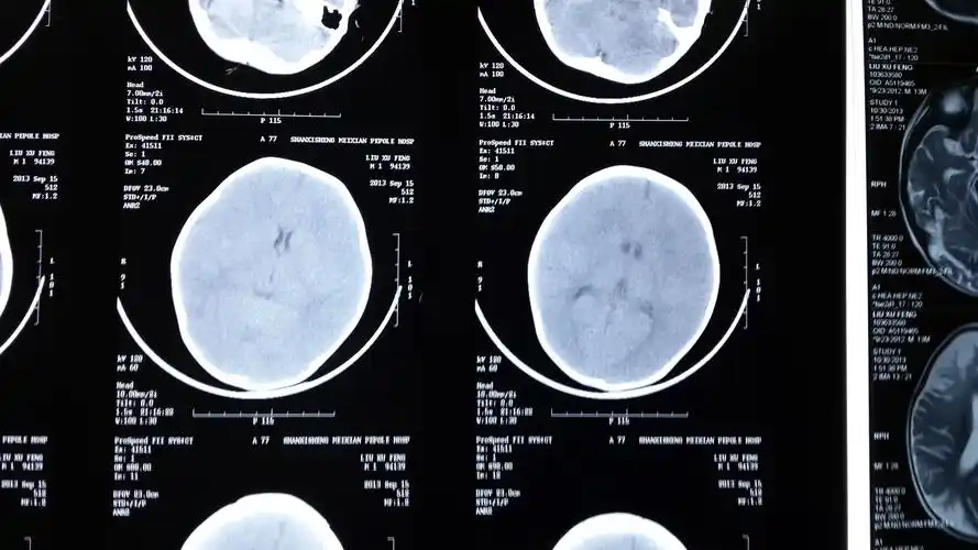 原创贺晓生教授拍案发言警惕婴幼儿颅脑损伤后广泛脑梗塞