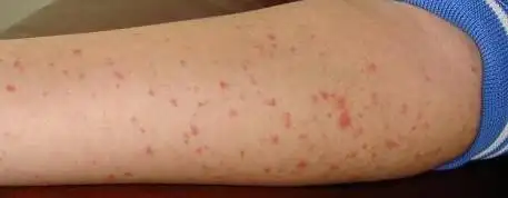 白血病出血点图片