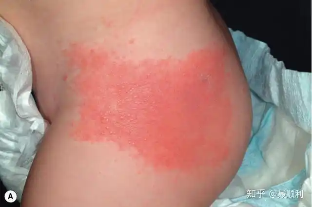 妈妈们的担心:尿布疹该如何诊断?