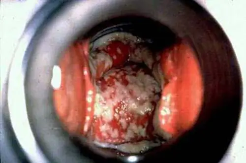霉菌性阴道炎图片_霉菌性阴道炎症状表现图片大全_有来医生