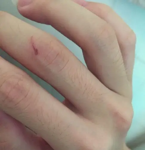 手被玻璃划伤 怎么防止留疤