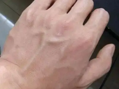 全身都青筋凸起的人小心得这病