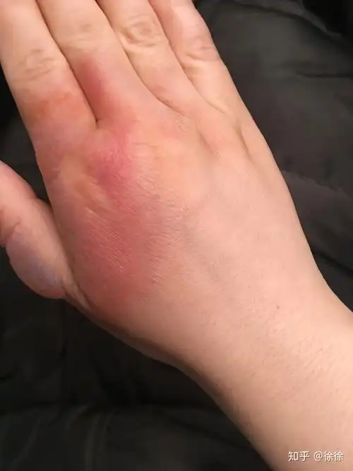 烫伤起的水泡可以戳破吗?