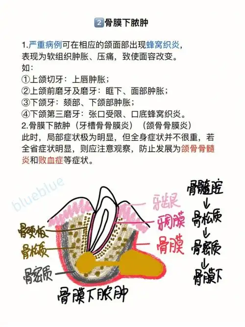 急性化脓性根尖周炎②