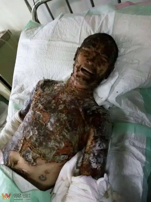 救助!车祸被截肢,被大火重度烧伤,一切不幸都发生在他身上!-宜宾零距