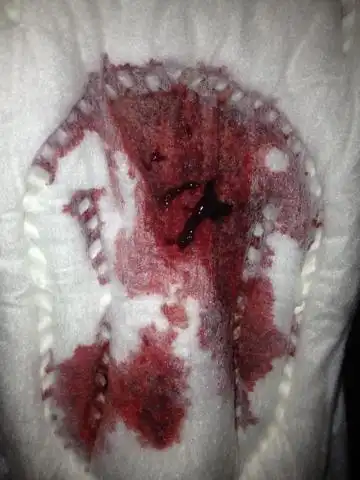 人流6天后开始不规律出血,现在20多天,出血越来越多,但不超过月经.