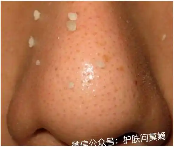你鼻子上的究竟是黑头?还是皮脂栓? "黑头 · 皮脂栓" 课程,3月30日