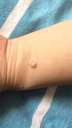 不根治全额退款!