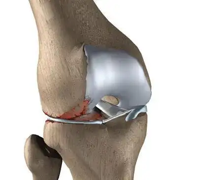 半月板损伤症状?