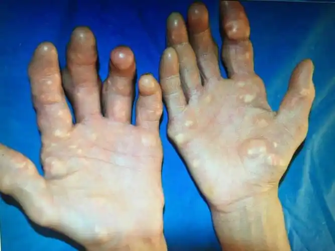 手部痛风结石 - 好大夫在线