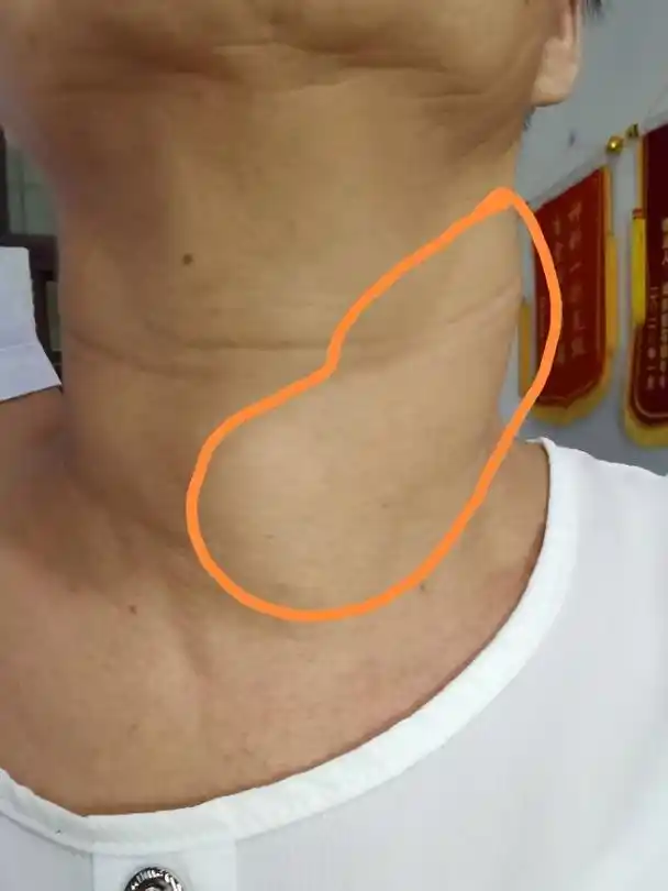 单纯性甲状腺肿_介绍_症状表现 - 好大夫在线