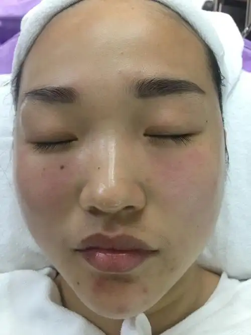 其它 刘维～混合性偏干肌肤 2018年5月24日 刘维 皮肤状况:皮肤底子