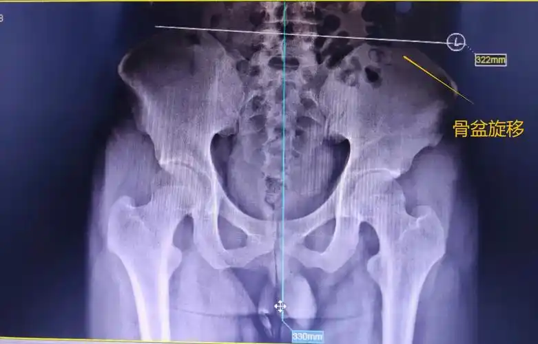 有一种腰腿疼痛叫骨盆旋移症