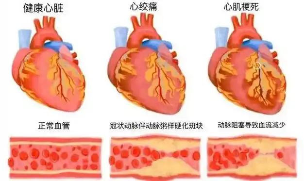 症状|冠心病|心绞痛|心脏病|急性心肌梗死_网易订阅