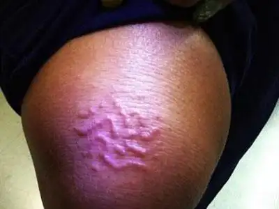 中医早已认识到寄生虫能引起疾病,并将之称为"虫积".