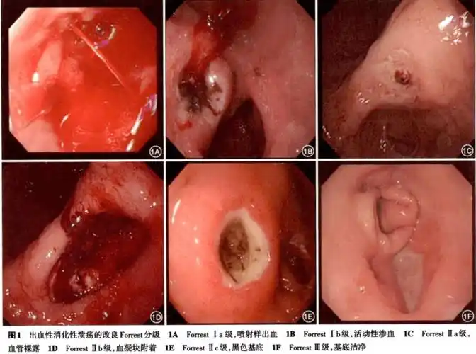 我院消化内镜中心成功救治一例急性上消化道出血的高龄患者