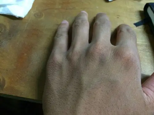 手背上突然出现一块黑斑