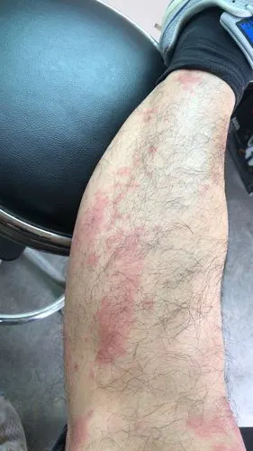 艾滋病初期皮肤症状,我们的皮肤怎么了?