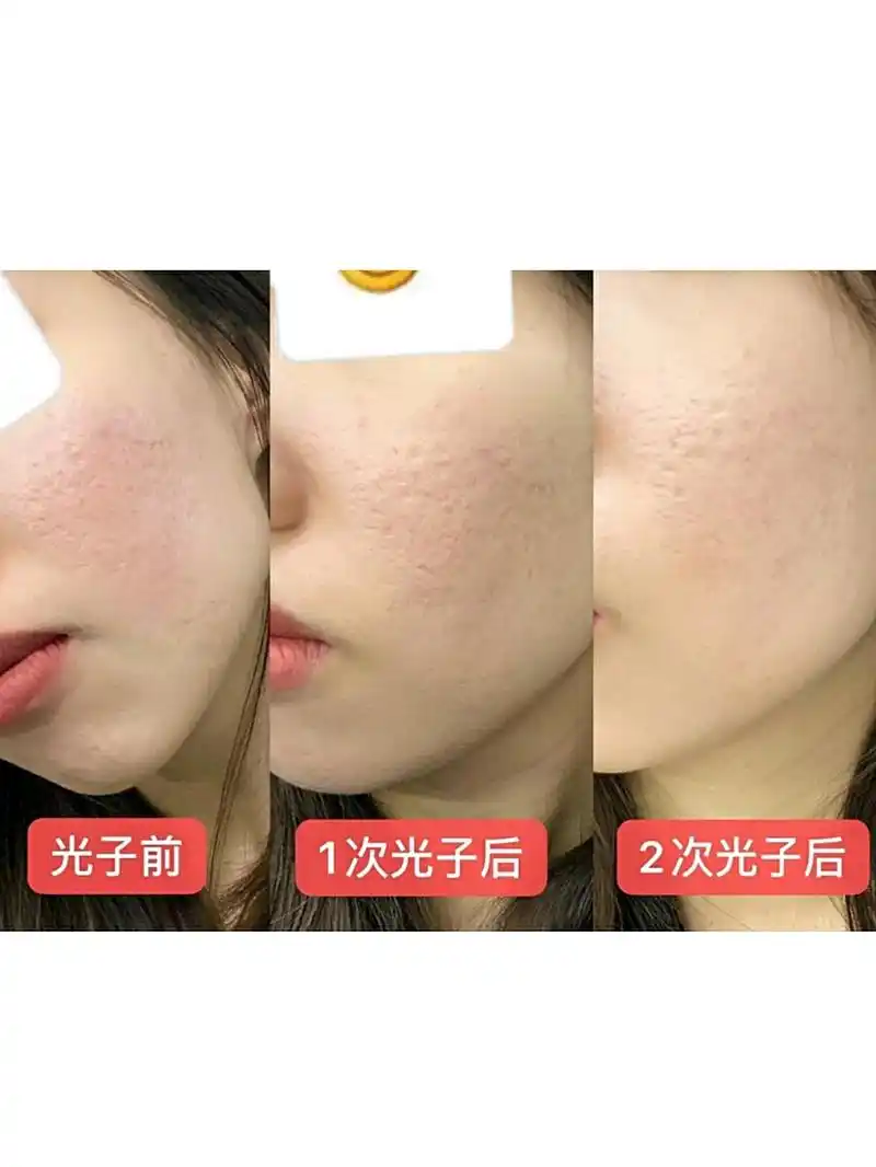 做了第二次光子嫩肤